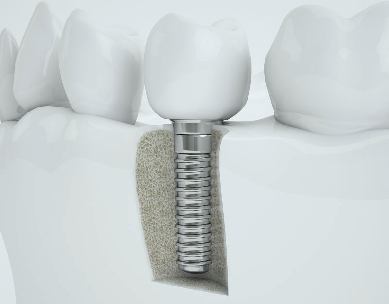 dental implant model Peabody, MA
