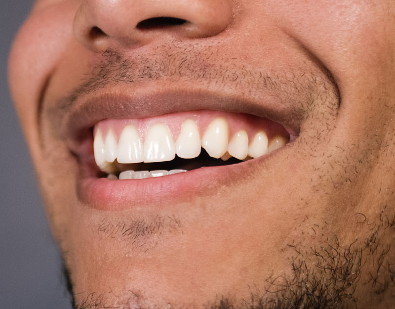 dental patient in need of soft tissue graft Peabody, MA