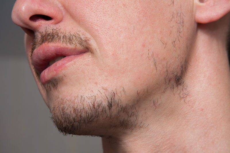 facial hair removal