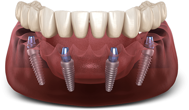 full arch dental implants graphic Peabody, MA